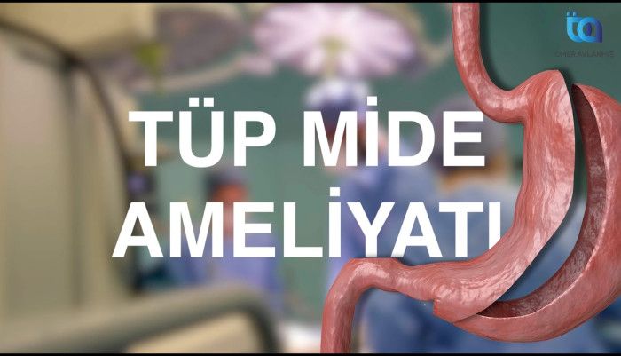 tüpmide,tupmide,obezitecerrahisi,diyet,sleevegastrectomy,sleevegastrektomi,mideküçültme,obesitysurgery,bariatricsurgery,istanbul,gastricbypass,gastrikbyass,kiloverme,diyetteyiz,weightlosstransformation,transitbipartisyon,weightloss,sekerhastaligiameli
